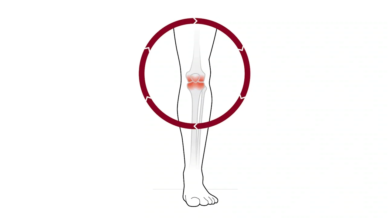 Diz osteoartriti ve ortez yaklaşımı: Ağrı ve hareketsizlik döngüsü diyagramı