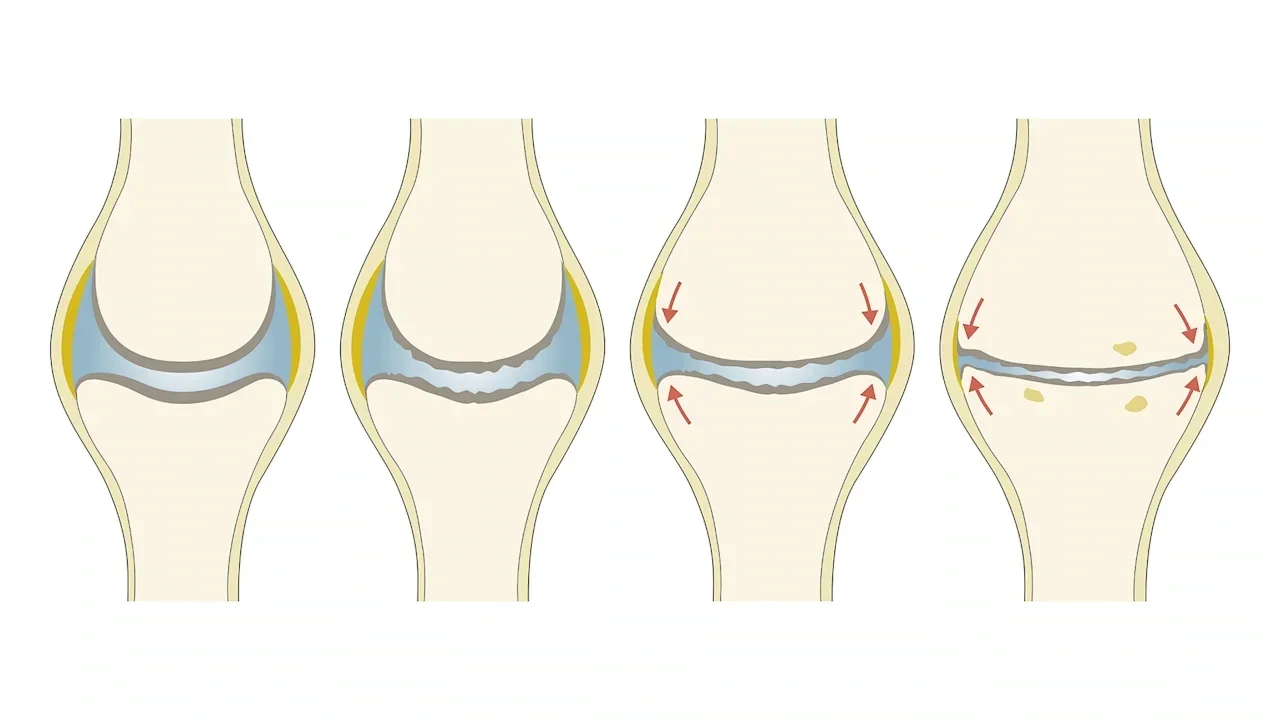 Diz osteoartriti ve ortez yaklaşımı: Diz osteoartritinin evrelerini gösteren çizim